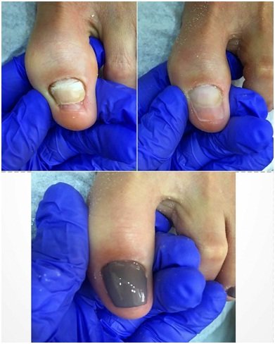 How to apply/get an acrylic toenail?